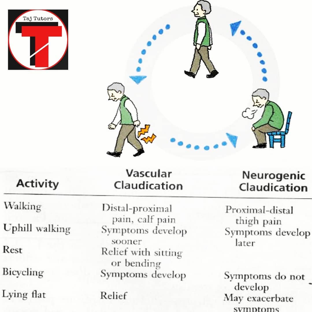 Taj Tutors - Neurogenic claudication (NC), also known as ...