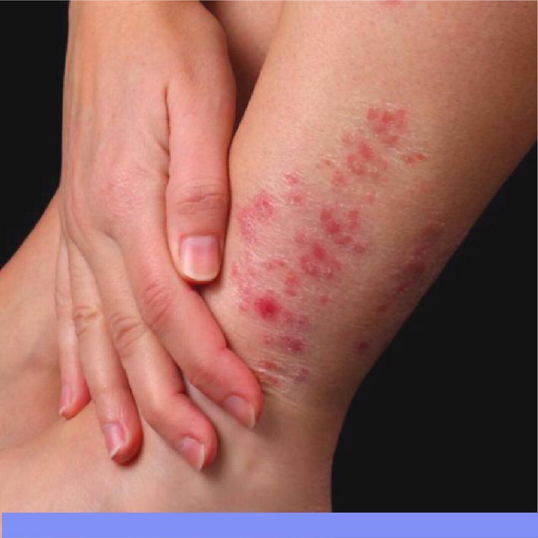 Due Derma - ⚠️⚠️ La #psoriasis puede asociarse a otras...