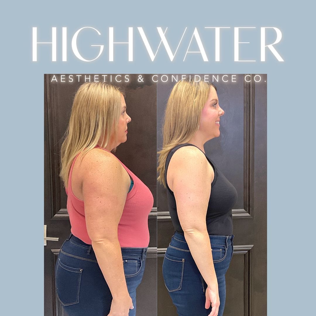 Semaglutide weight loss results at Robyn Molo Aesthetics