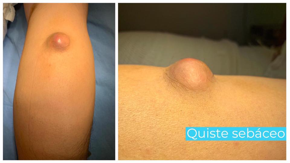 Diferencias Entre Quiste Sebáceo Y Lipoma. – JPNQ