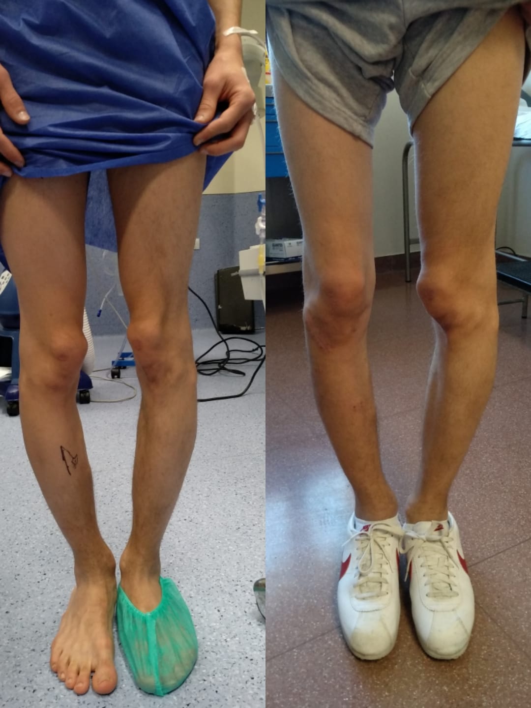 Clínica Adler · Cirugía de rodilla - Caso severo de deformidad de ...