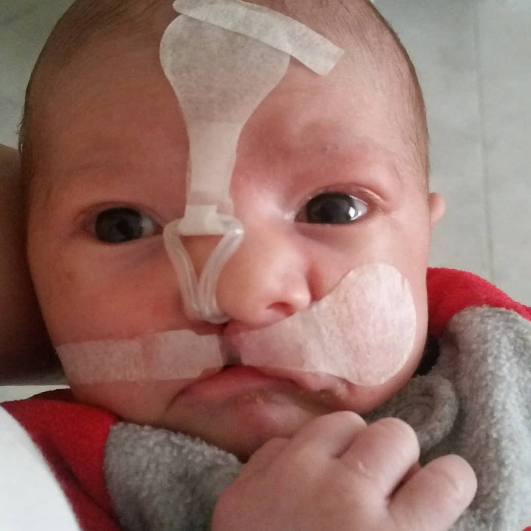 Baby Henry was born with a cleft palate. Where his upper lip should have been, a large hole gaped to his nose. When Henry came to Children's Hospital Los Angeles in 2011