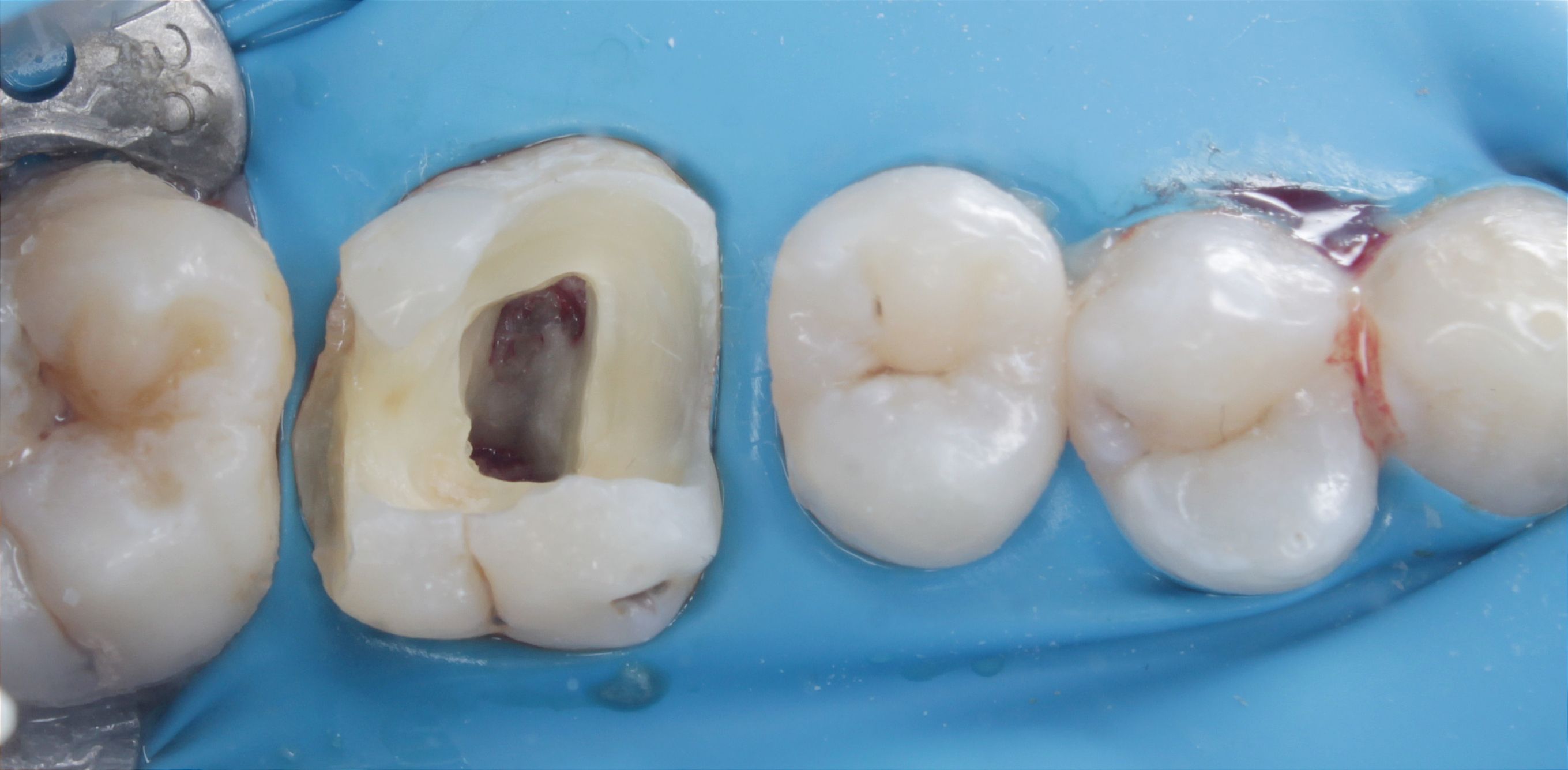Vital pulp therapy Direct composite