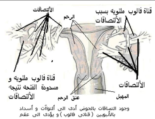 ما هي التصاقات الرحم من عيادة طبية الدكتورة عقاب عائشة فيسبوك