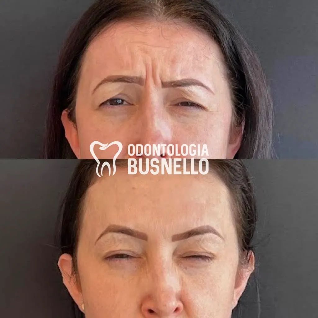 Ruga da glabela, mais conhecida... - Odontologia Busnello | Facebook