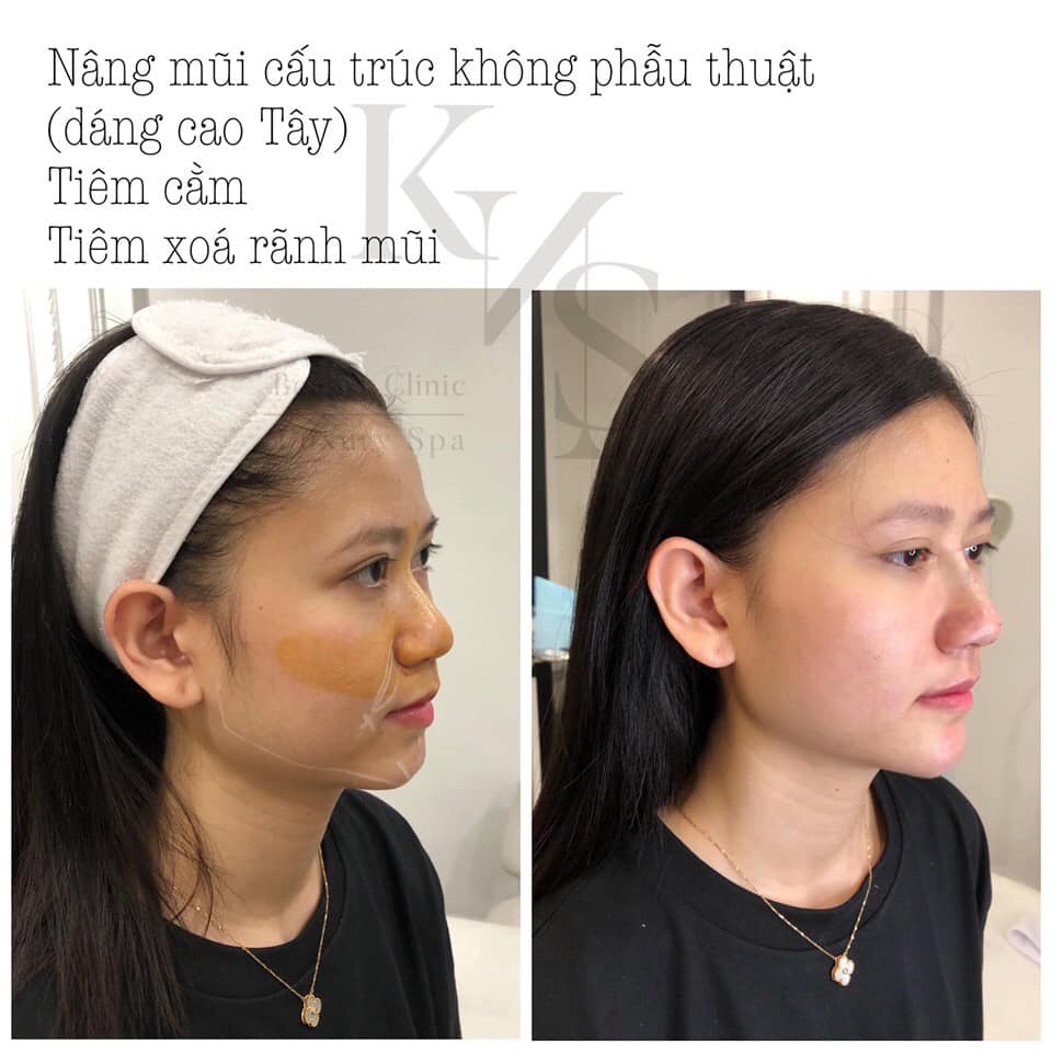 Khiet Nhu Spa & Aesthetic - Viện thẩm mỹ công nghệ cao - 💕 Chỉ 30 phút ...