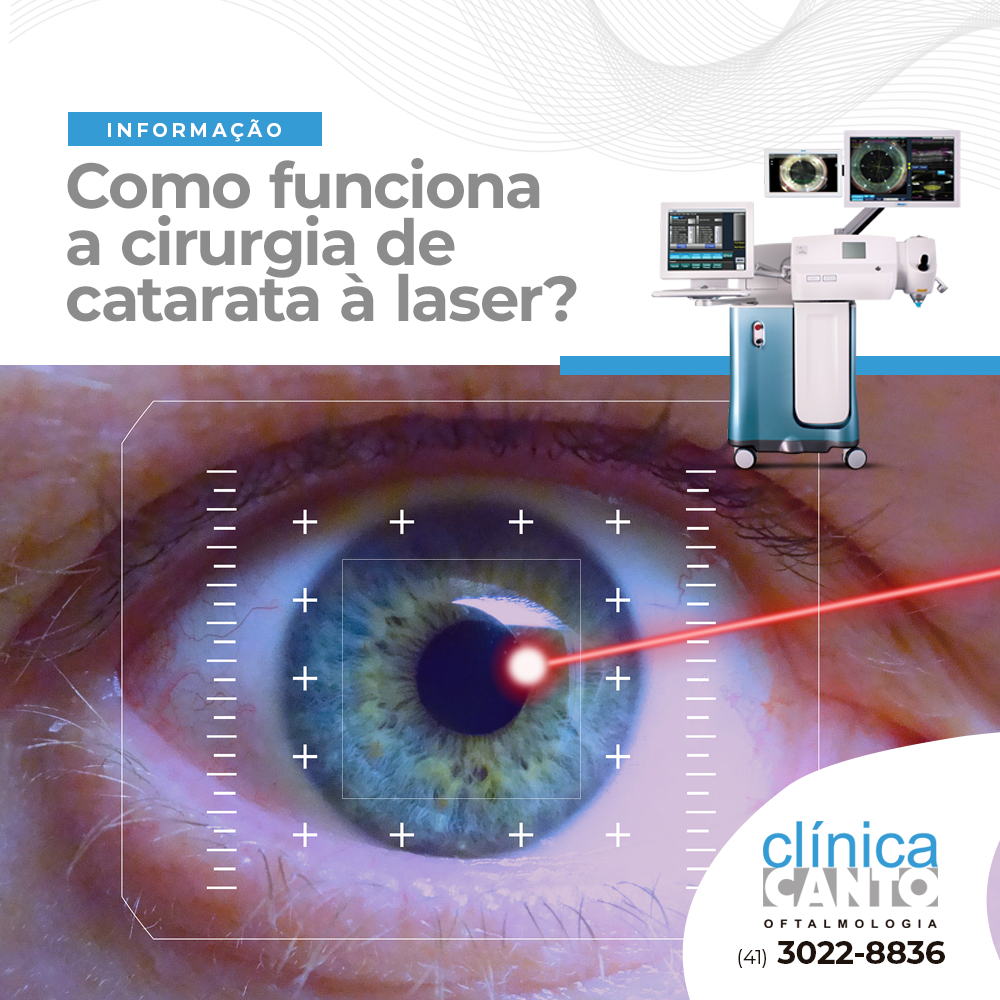 Clínica Canto Oftalmologia - 👁 A cirurgia de catarata a LASER é uma ...