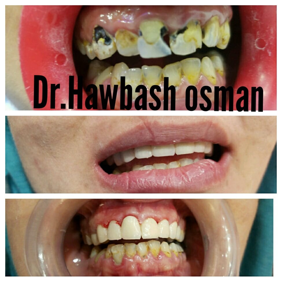 دروستکردنی (۱۰)... - کلینیکی پزیشکی ددان Dr.Hawbash Osman