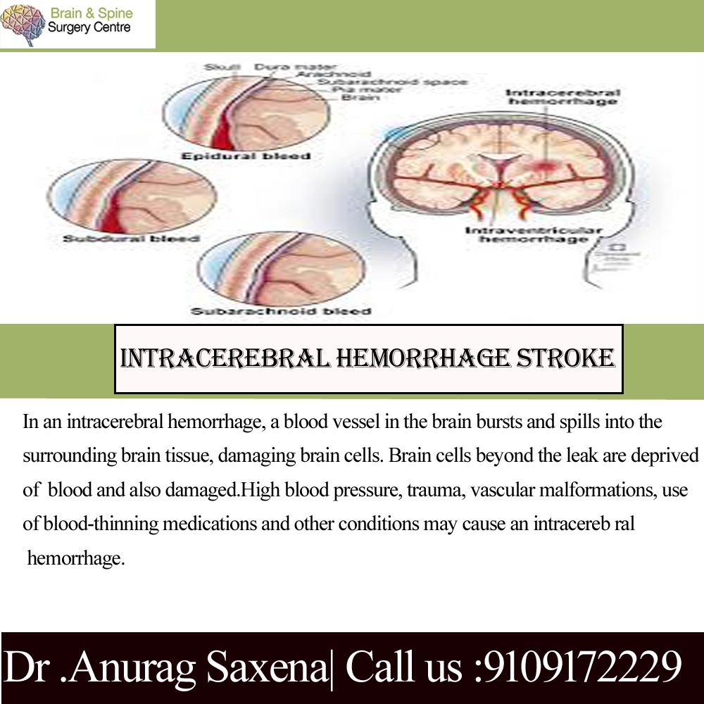 Intracerebral hemorrhage Stroke... - Brain and Spine India | Facebook