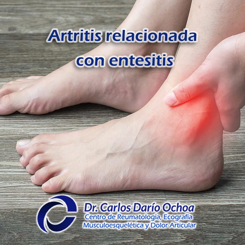 Dr Carlos Ochoa - La entesitis hace referencia a la... | Facebook