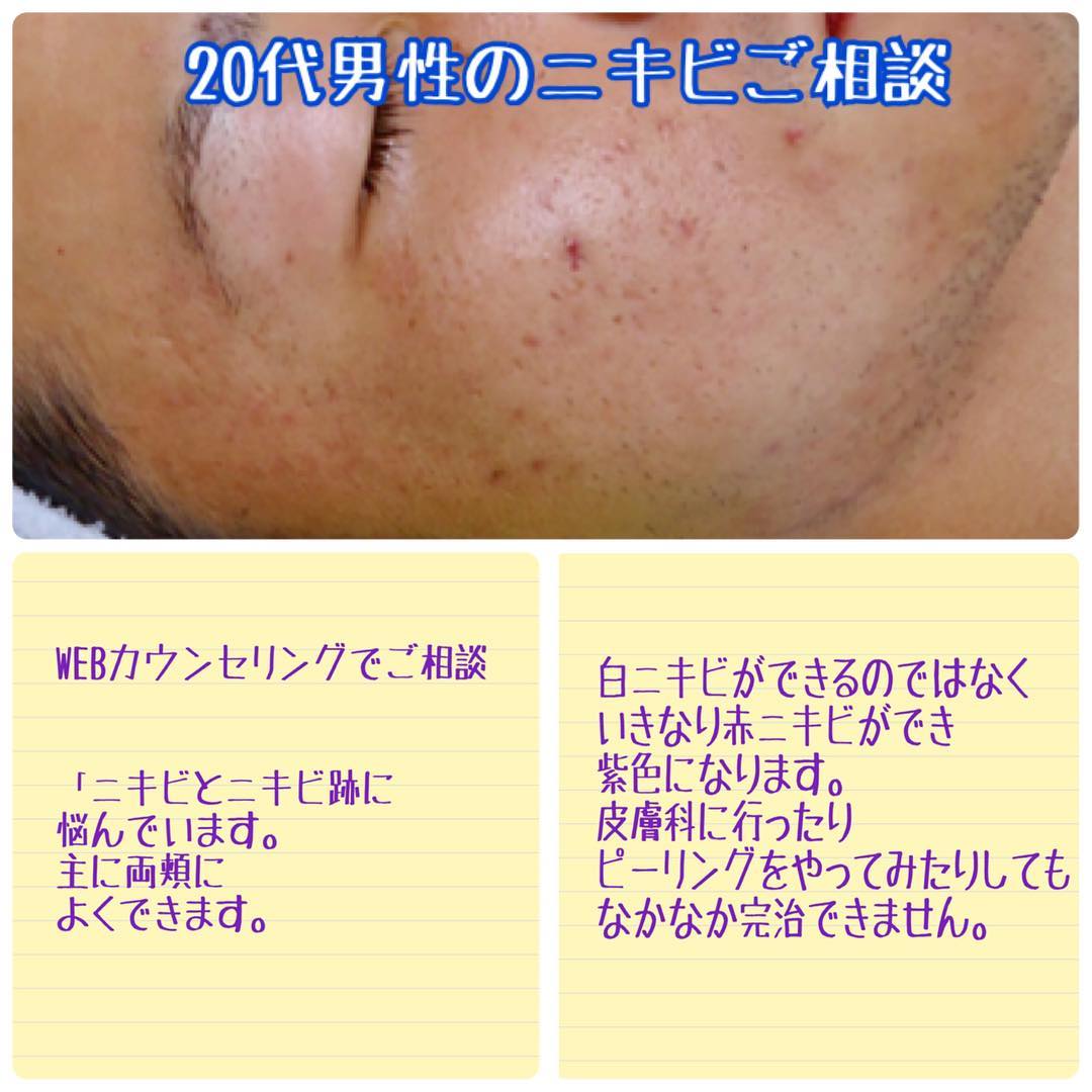 ゼオスキン 両頬のニキビ痕と他院で受けたレーザー後色素沈着も綺麗に セイコメディカルビューティクリニック 美容皮膚科 美容外科 医療脱毛 福岡 天神