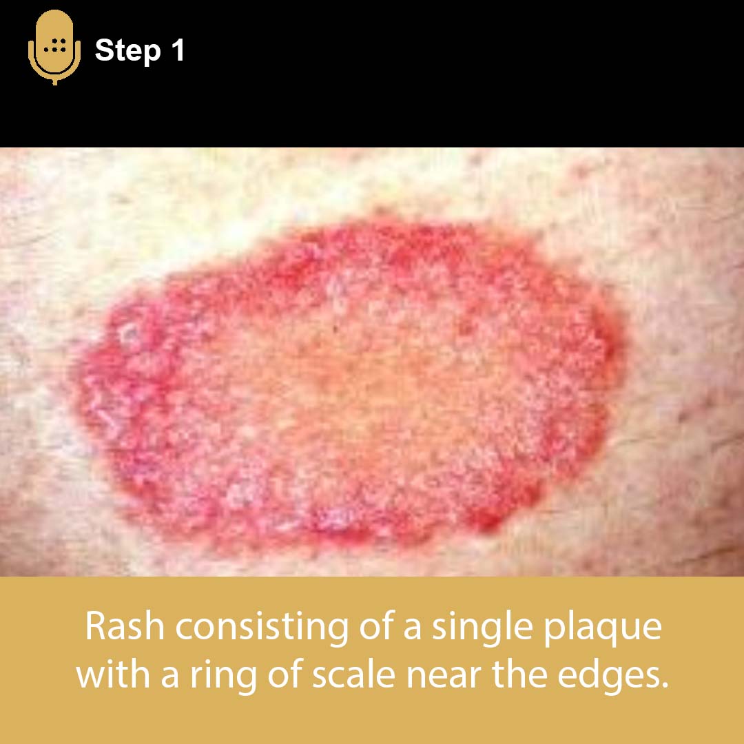 Medbullets - Pityriasis is a very common, self-limited papulosquamous ...
