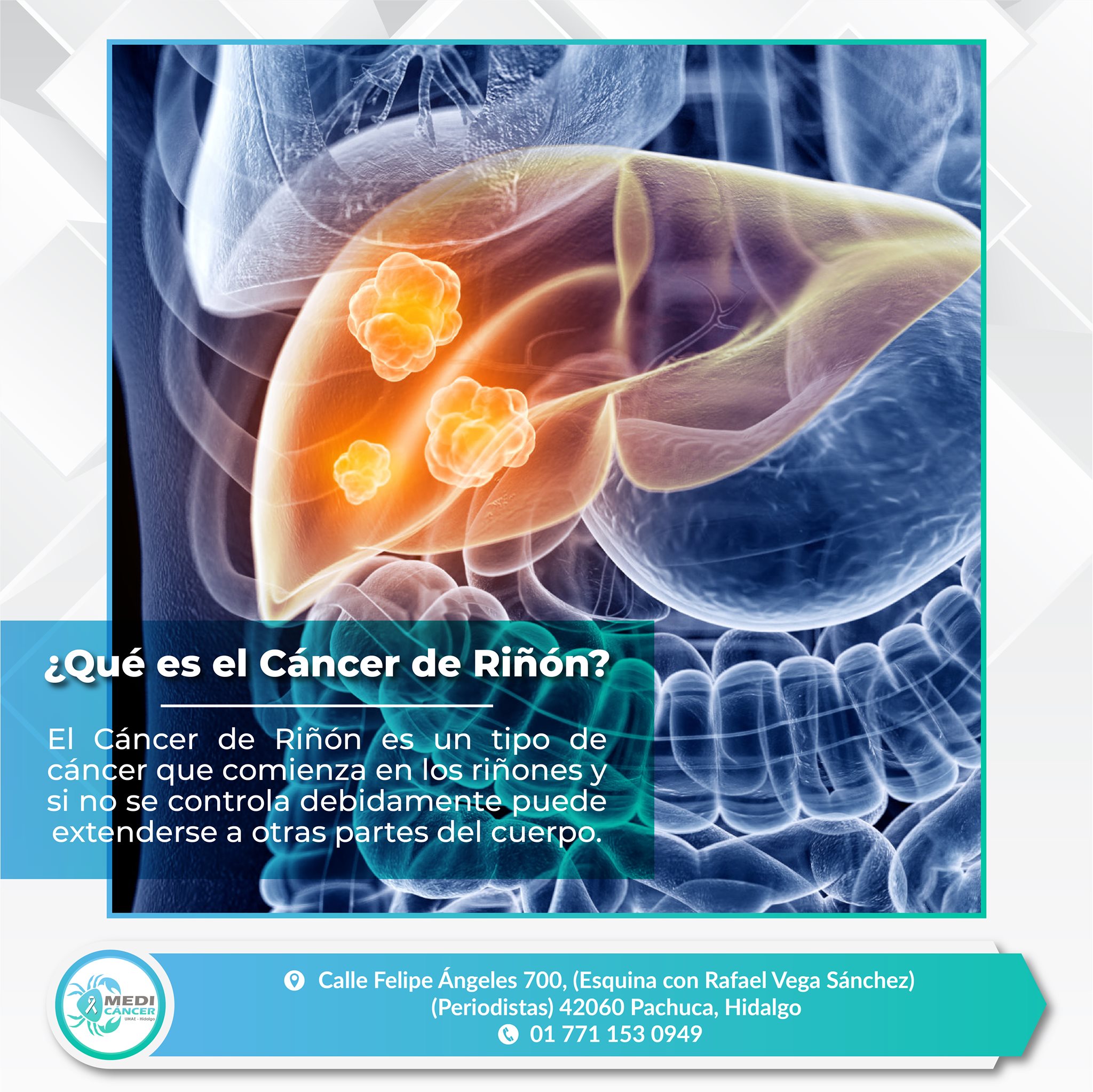 MEDI - #CáncerDeRiñón Los cánceres de riñón en etapas iniciales por lo ...