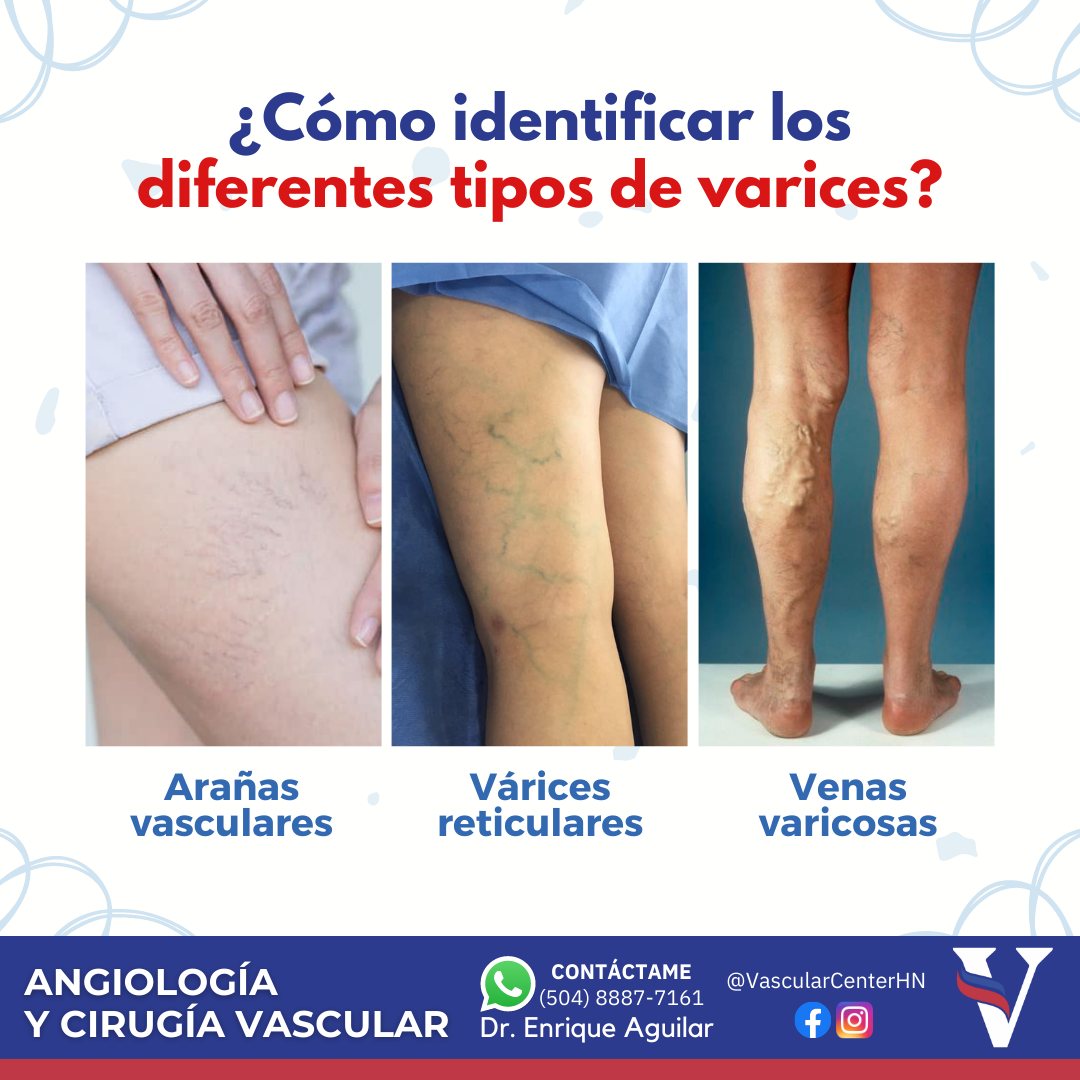 🔴Las arañas vasculares, son venas... - Dr. Enrique Aguilar