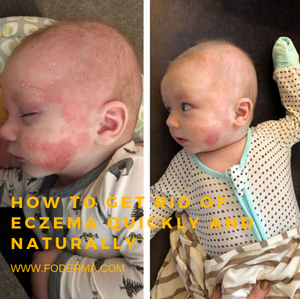 Foderma - How To Get Rid of Eczema Quickly And Naturally Eczema is a ...