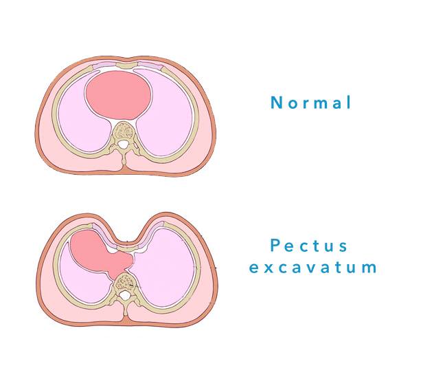 El pectus... - Protorax de Colombia. Cirugía de Tórax. | Facebook