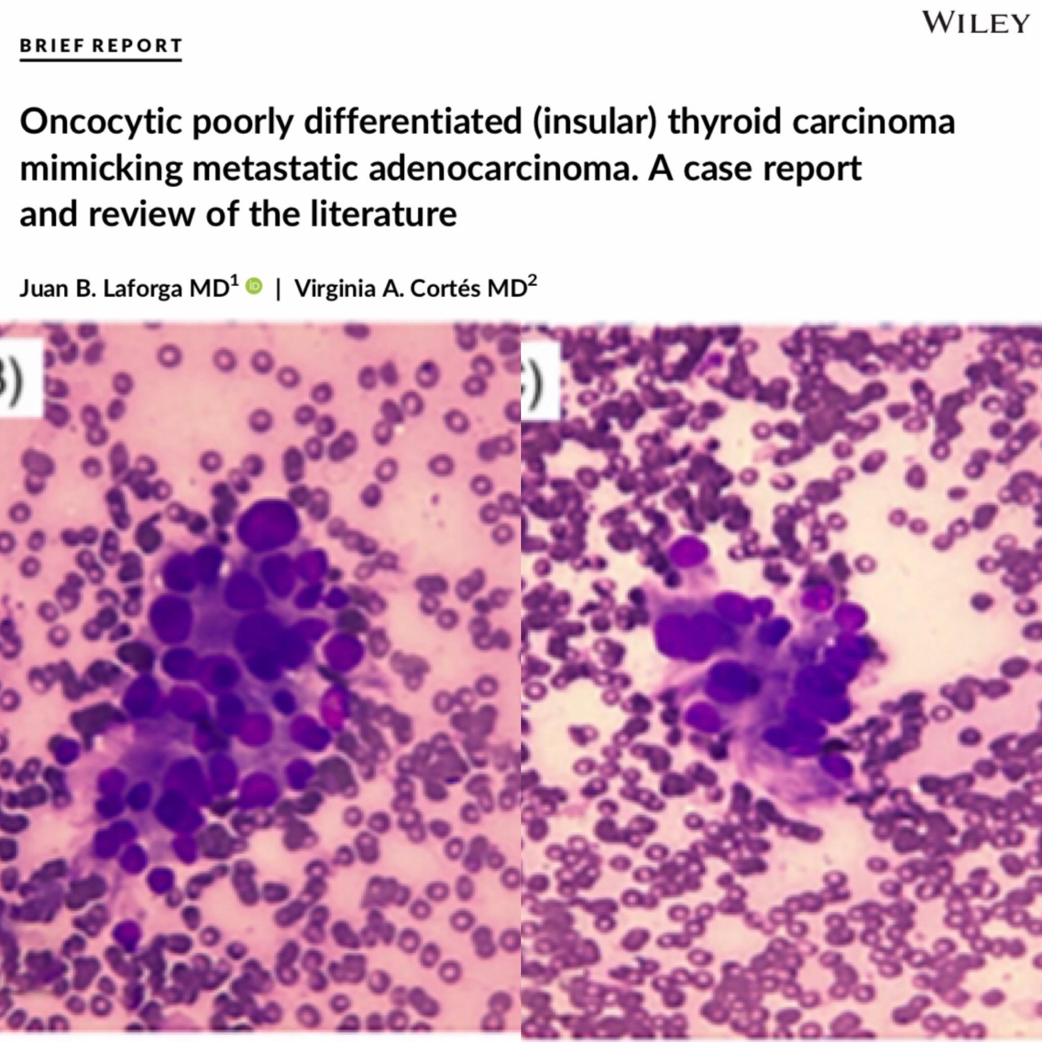 Diagnostic Cytopathology - Oncocytic poorly differentiated (insular ...