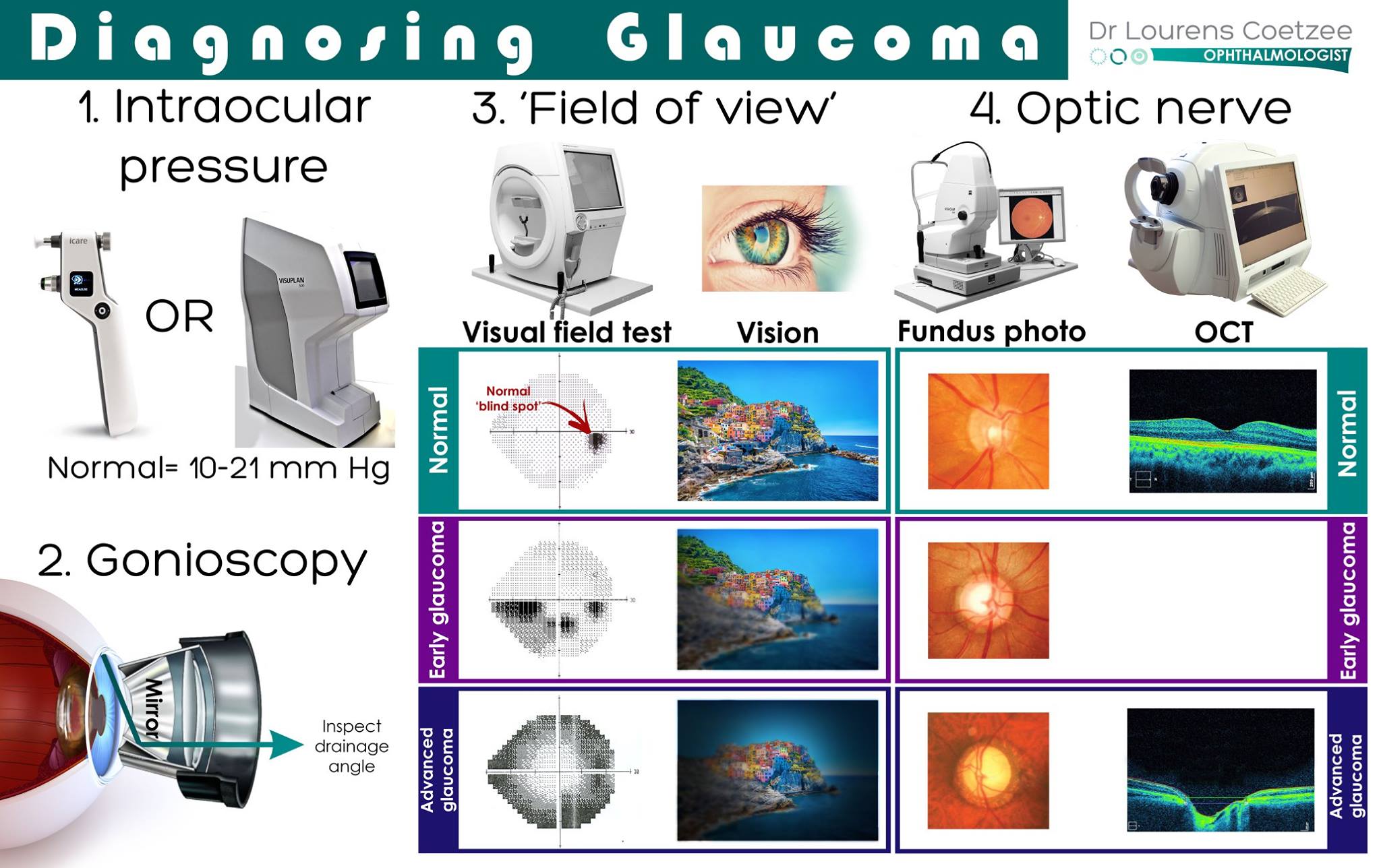Diagnosing glaucoma? It is essential... - Dr Lourens Coetzee | Facebook