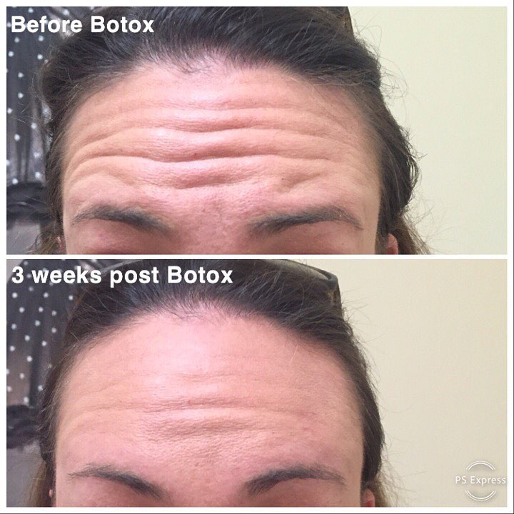 Revive Medspa - We were very conservative with her Botox... | Facebook