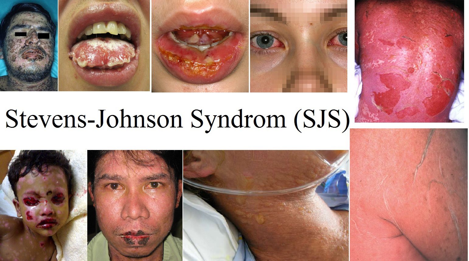 glutathione steven johnson syndrome What causes red man, gray baby, and syndromes? BPC-157 & The Gut-Brain Size:8 oz. Species Rat