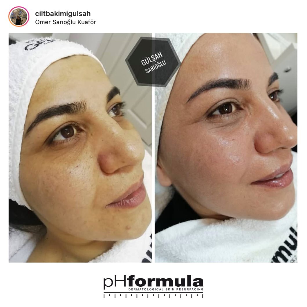 igf 1 lr3 peptide reason and globlend peptide IGF-1 in Aesthetic Anti-Aging Medicine: Benefits and Risks Original Glutathion Extra Brightening VAT_Standard Deposit/ Full Payment:Deposit
