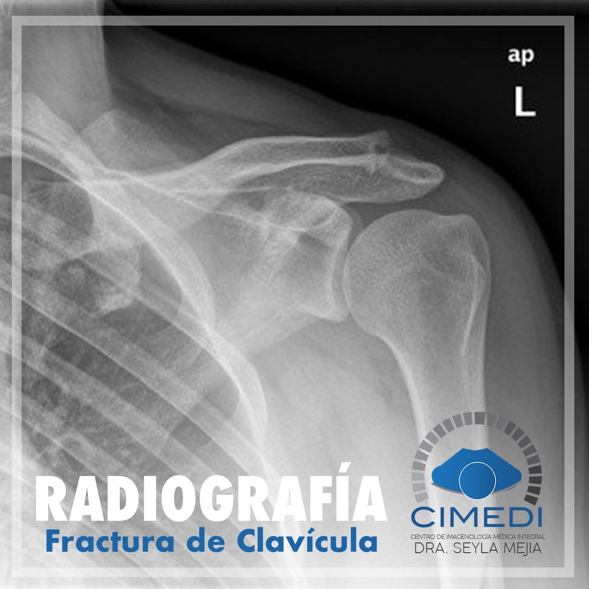Cimedi - Las fracturas de clavículas son lesiones muy...