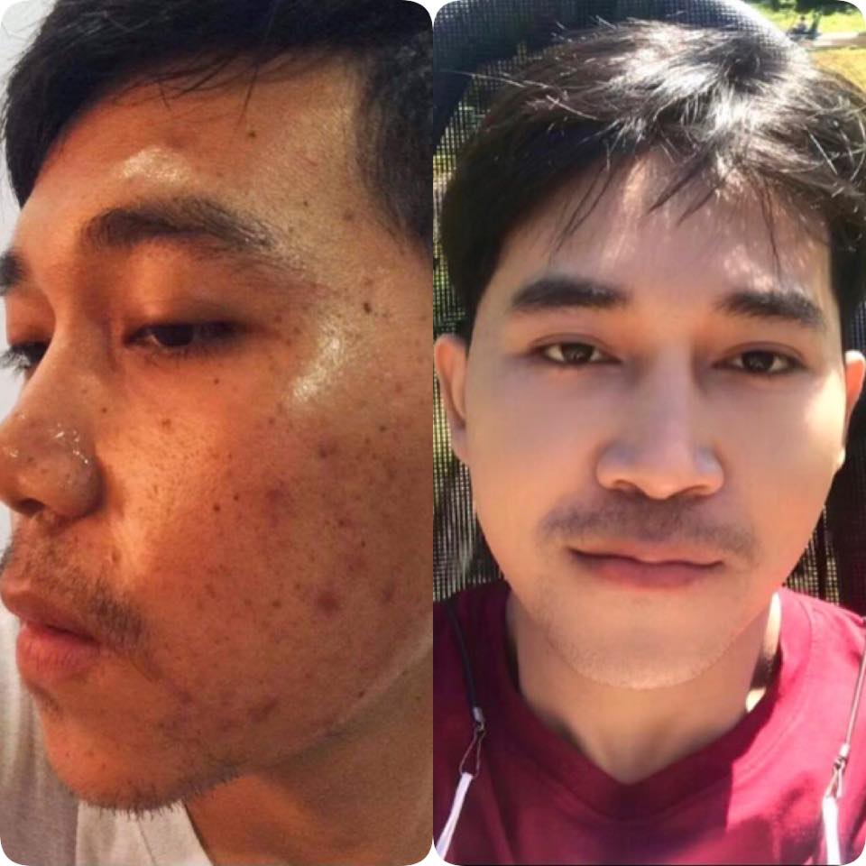 😱#PRPกู้หน้าพังกลับมาโปรแกรมฟื้นฟ... - Princess Medical Clinic | Facebook