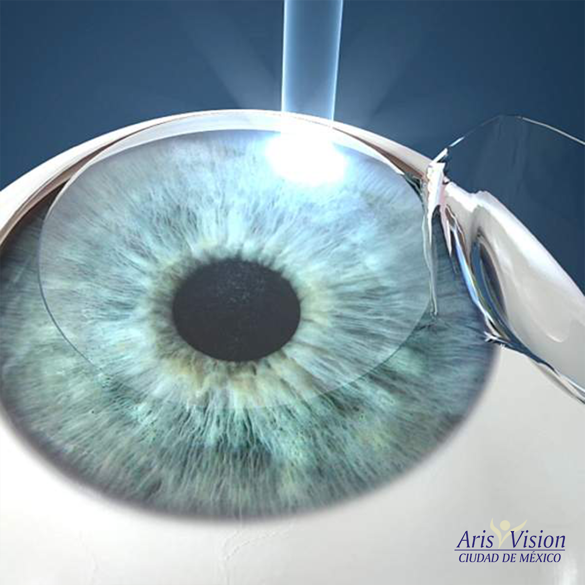 La cirugía ocular LASIK modela mediante... - Aris Vision CDMX | Facebook