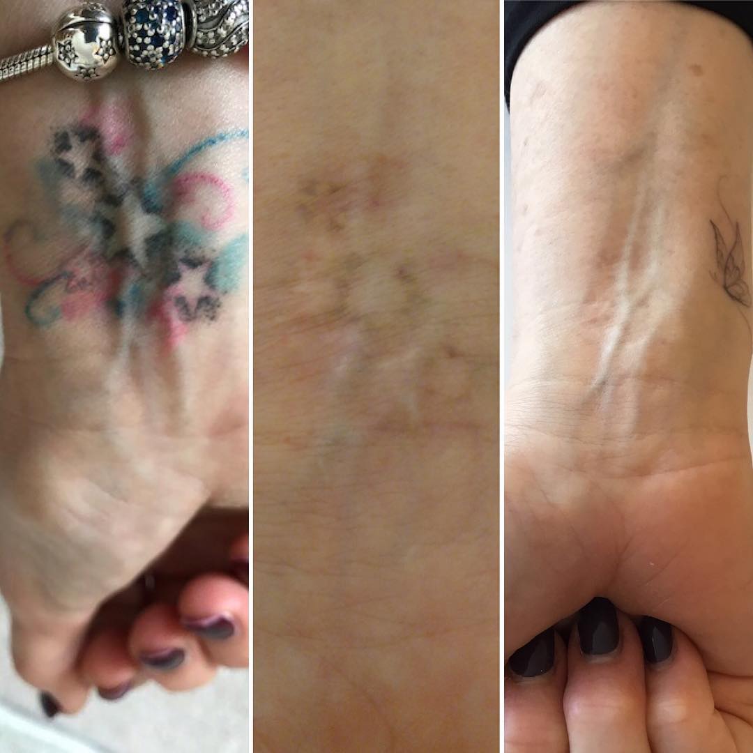 Before After 4 And Then 7 Picosure Zapp Laser Studio Facebook