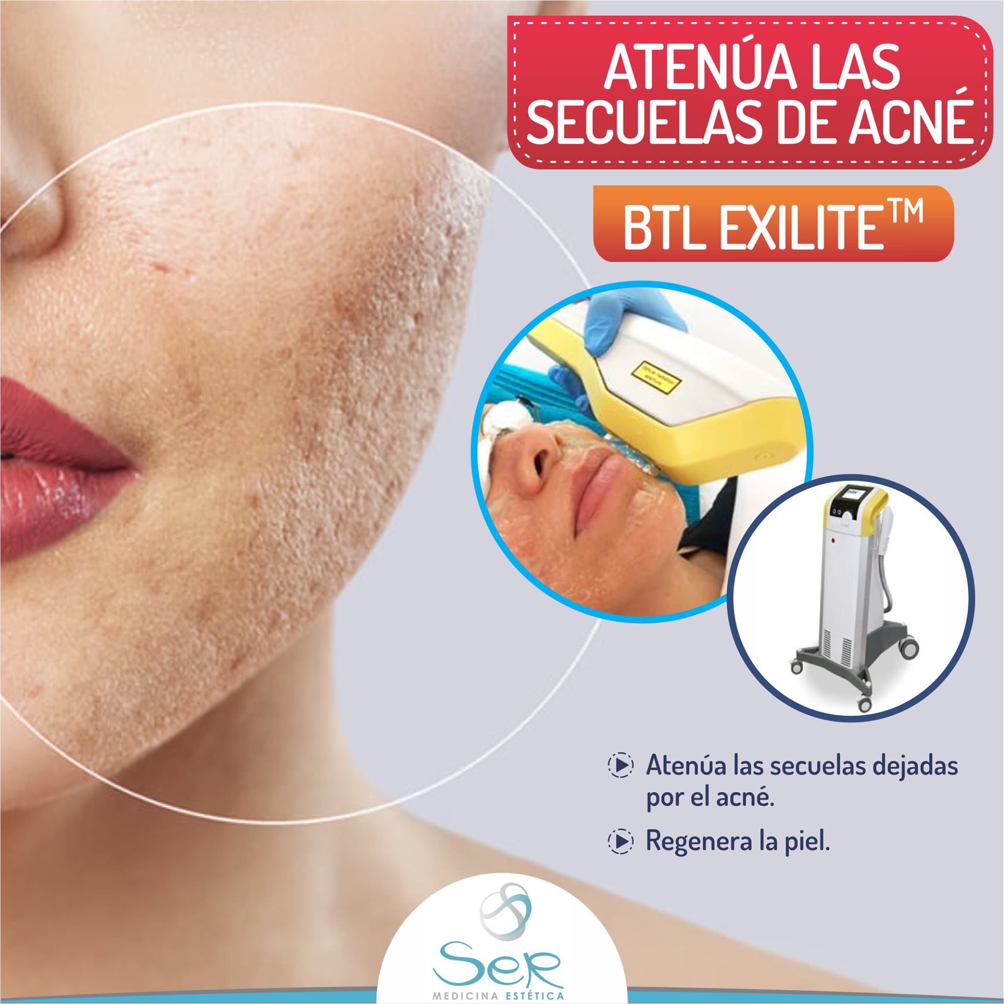 🌷La tecnología BTL EXILITE ™ es... - Medicina Estética SER | Facebook