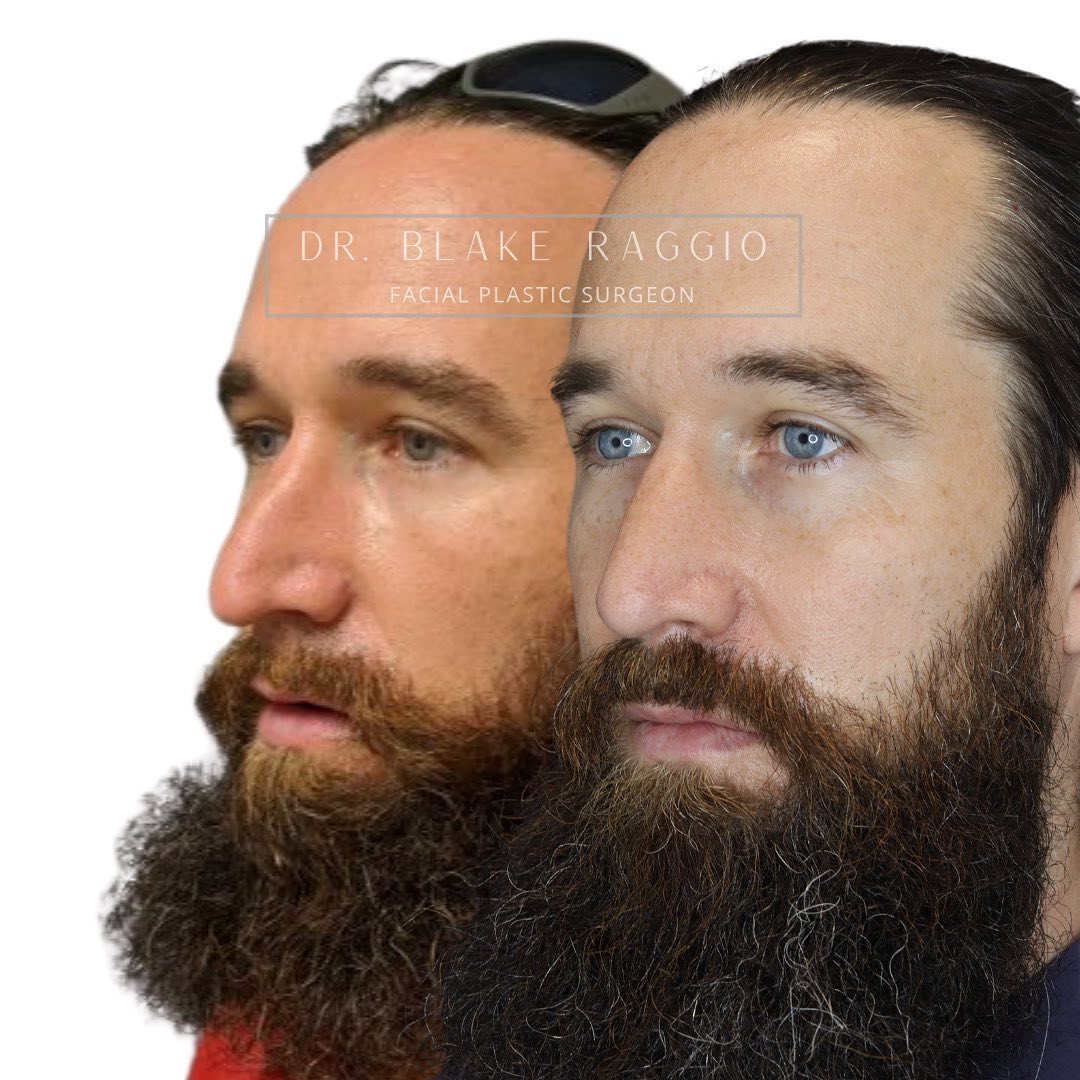 Did you know that Rhinoplasty (nose... - Dr. Blake Raggio | Facebook