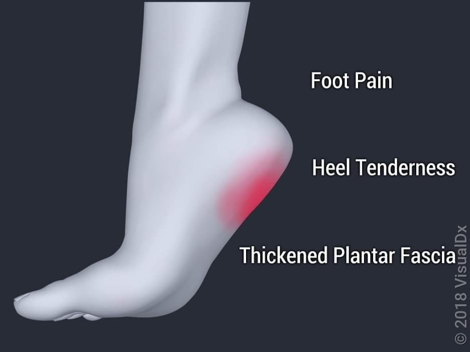 bpc-157 for plantar fasciitis I started using (sublingual strips) because Im looking something that can support healing from  a chronic foot issue Ive been struggling with as a nurse whos Peptides are here , Im