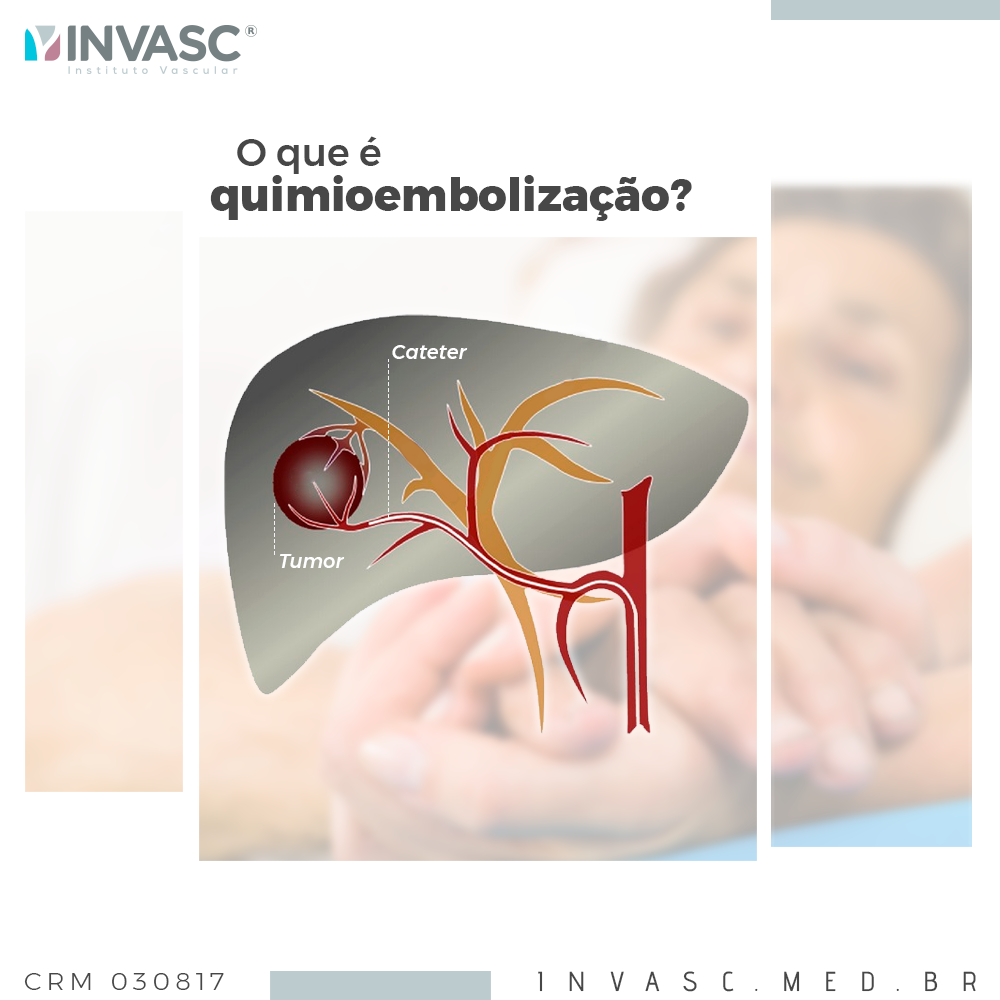 É um tratamento endovascular... - Invasc - Instituto Vascular