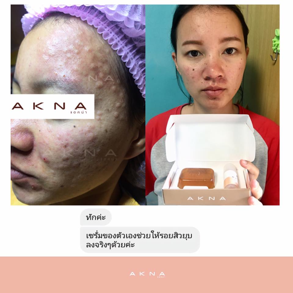 รีวิวอาสาสมัครผู้ใช้จริง100%... - AKNA เวชสำอางบำบัดผิว | Facebook