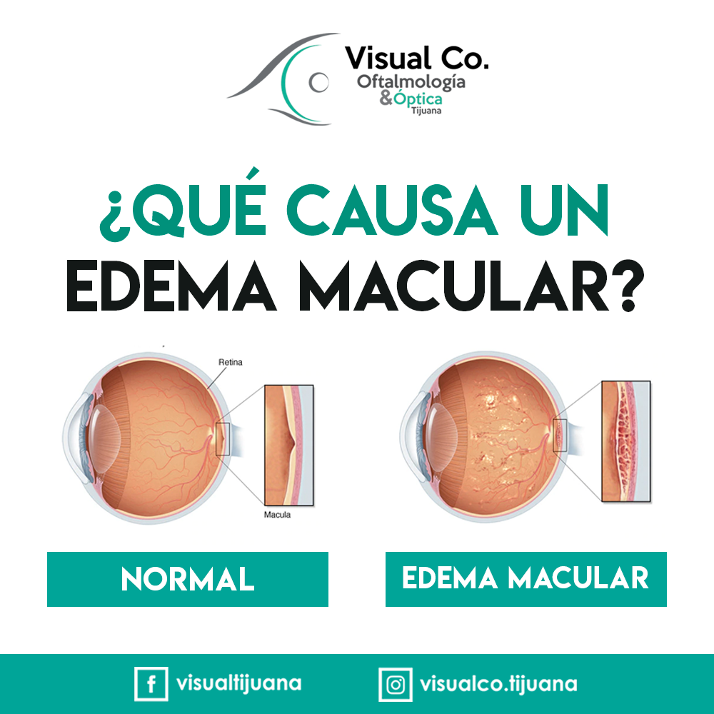 El edema... - Visual Co. Tijuana Oftalmología & Óptica