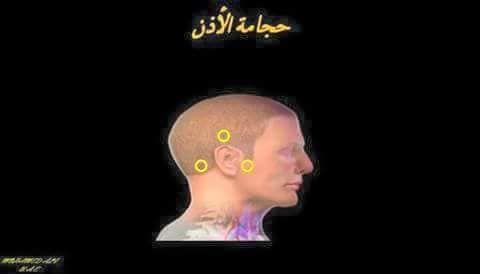 طنين الاذن إشراقة الأمل للحجامة Facebook