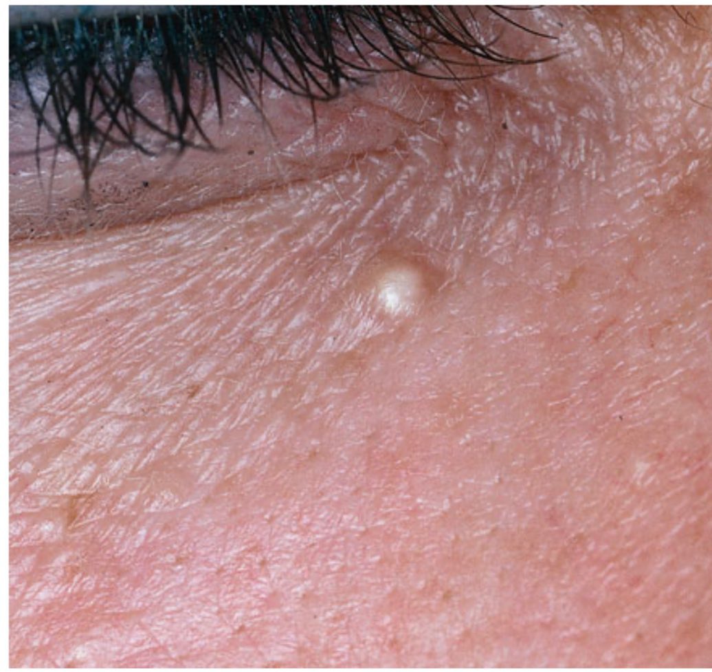 Drfernandezfr Quiste De Milium Introduccion Estas Pequenas Papulas Blancas De 1 A 2 Mm Que Se Encuentran Comunmente Alrededor De Los Ojos Y En La Parte Superior De La