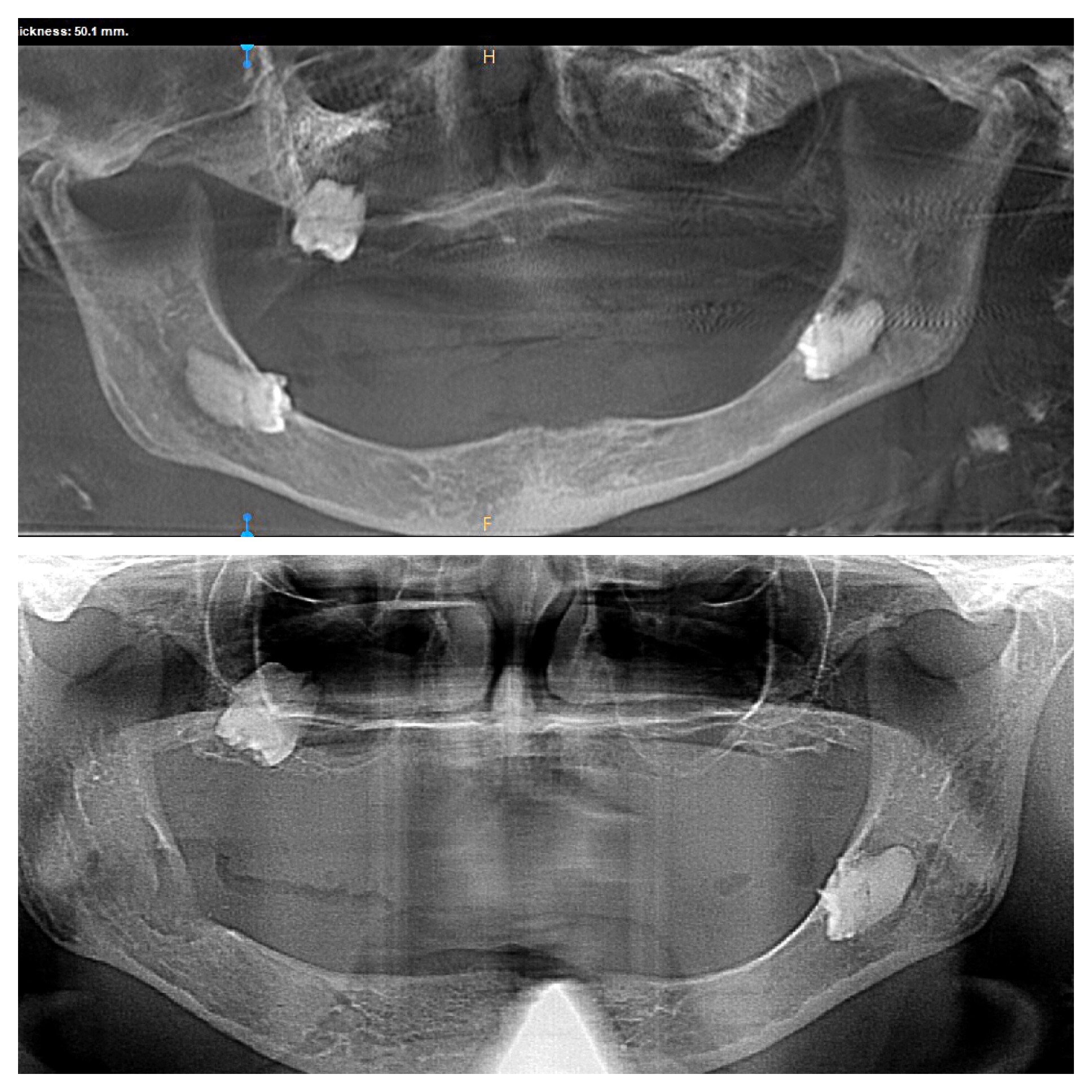 Dr. Hardeep Dhaliwal, MD, DMD - Here is a panoramic radiograph of a 72 ...