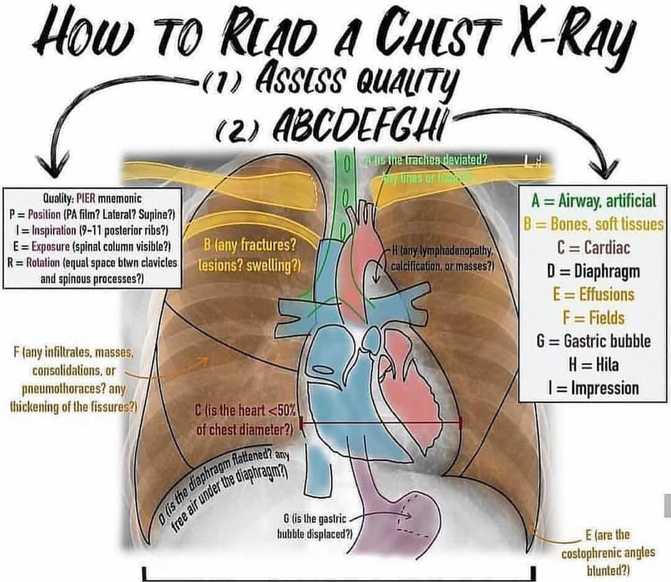 How to read a chest X-ray... 🩺... - The Specialist Paramedic | Facebook