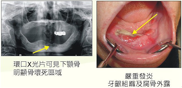 三軍總醫院 牙科吳契聰醫師提醒大家服用骨質疏鬆藥物病患 拔牙時要小心 Facebook