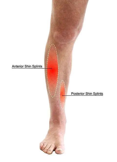 bpc 157 shin splints How to get rid of before a half marathon? B12 Shot Injection Vitamin 10 ml Size:.5 Gram