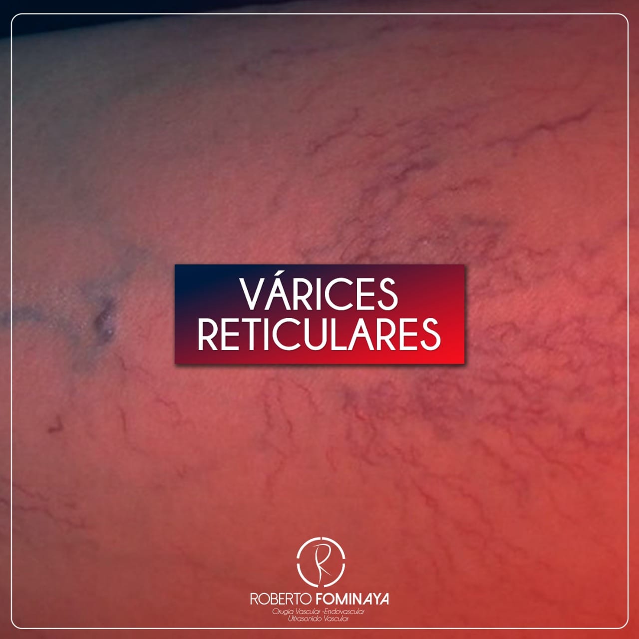 Las várices reticulares son venas... - Dr. Roberto Fominaya | Facebook