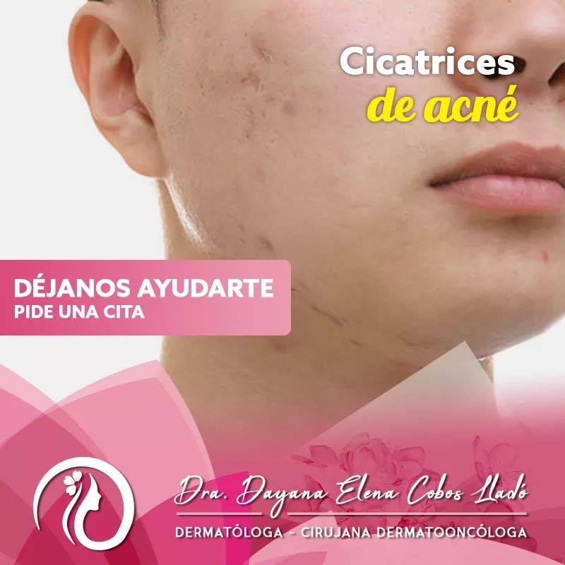Dra. - ¿En qué consiste la subcisión de cicatrices de acné? Se trata de ...