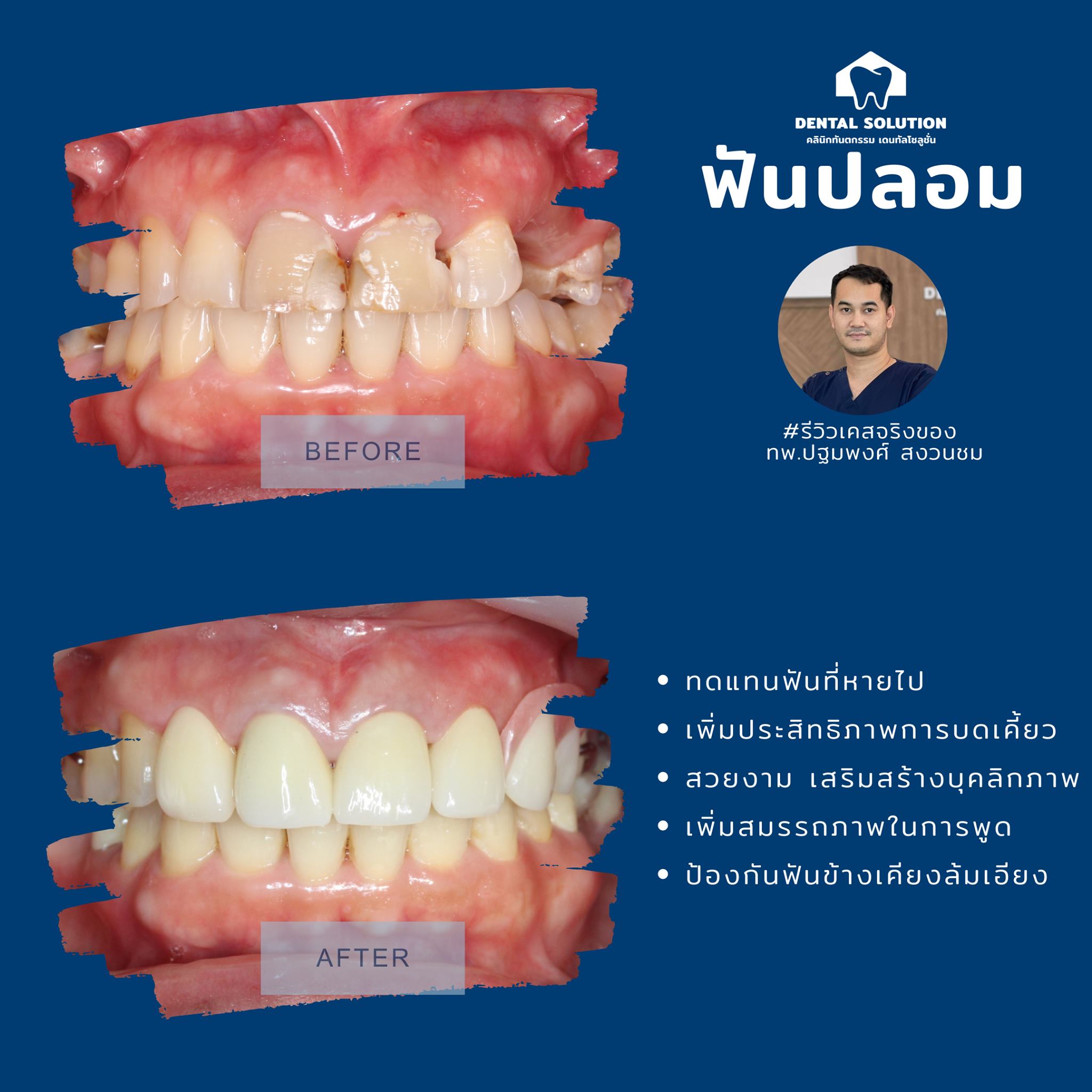 ปัญหาฟันหลอ ฟันบิ่น ฟันแตก การสูญเสียฟันธรรมชาติ สามารถทดแทนได้ด้วยการ ...