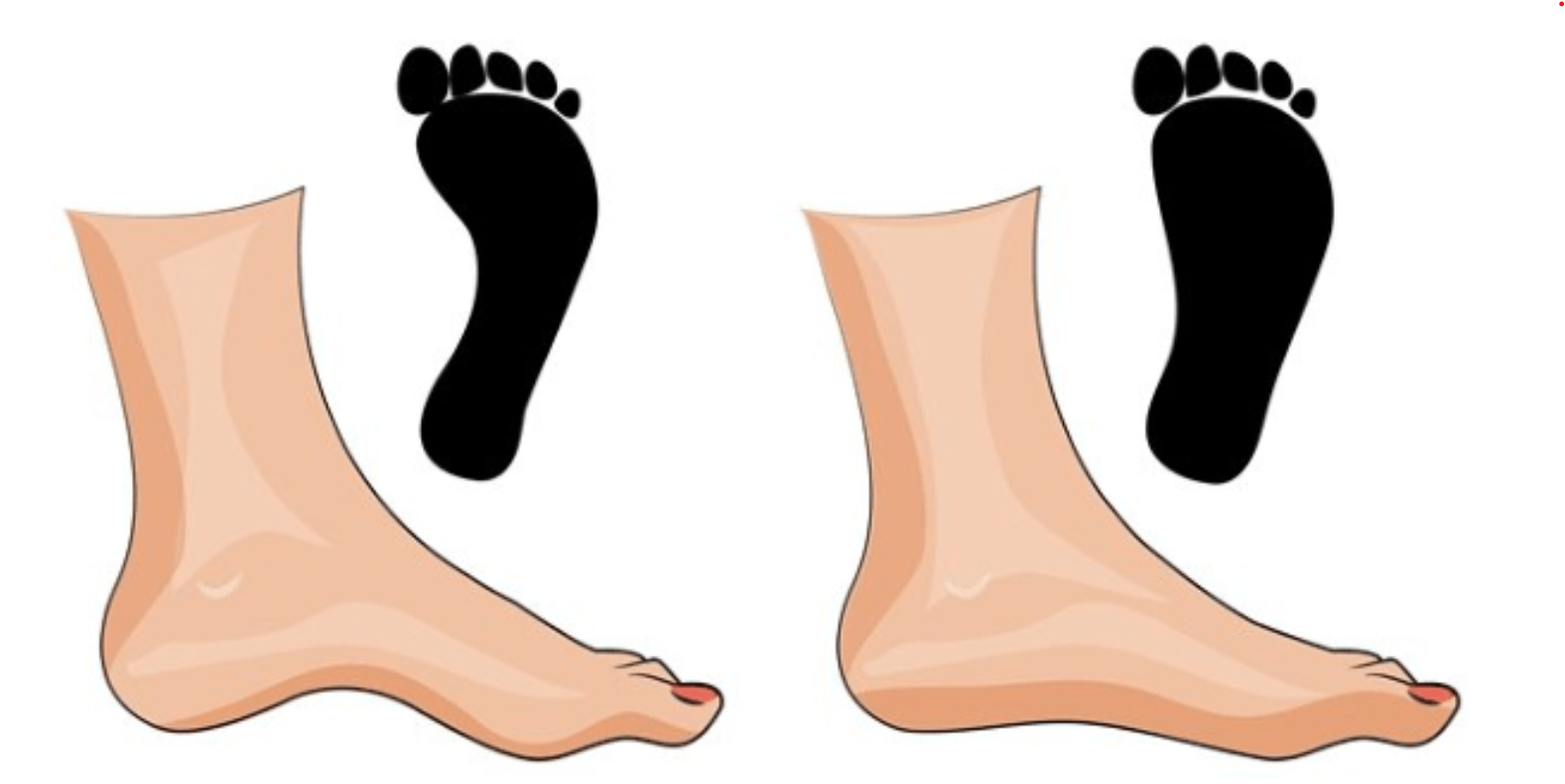 Riverview - Flat feet – also known as pes planus – is a foot deformity ...
