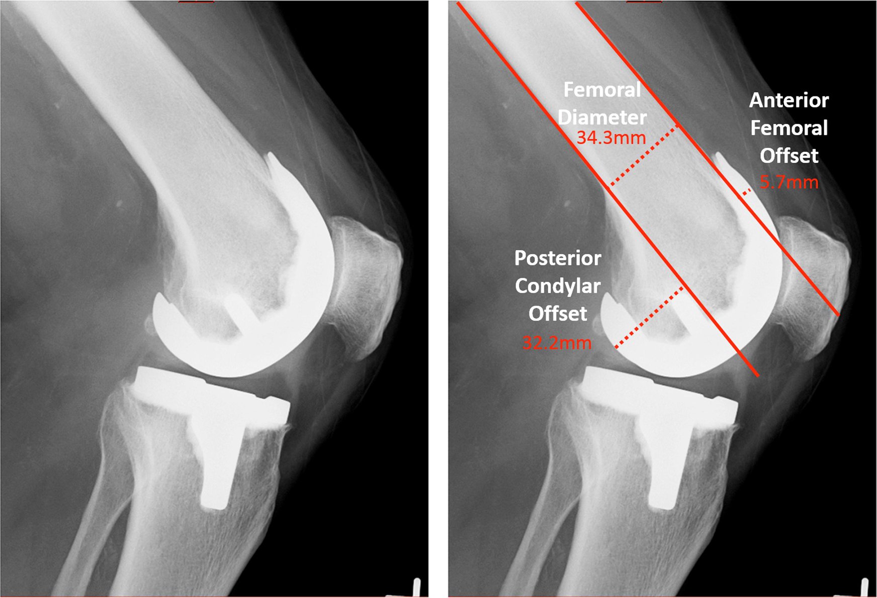 The Journal - Association Between Femoral Component Sagittal ...