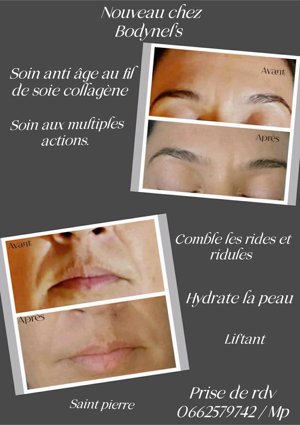 Fils De Soie Collagène Avant Après