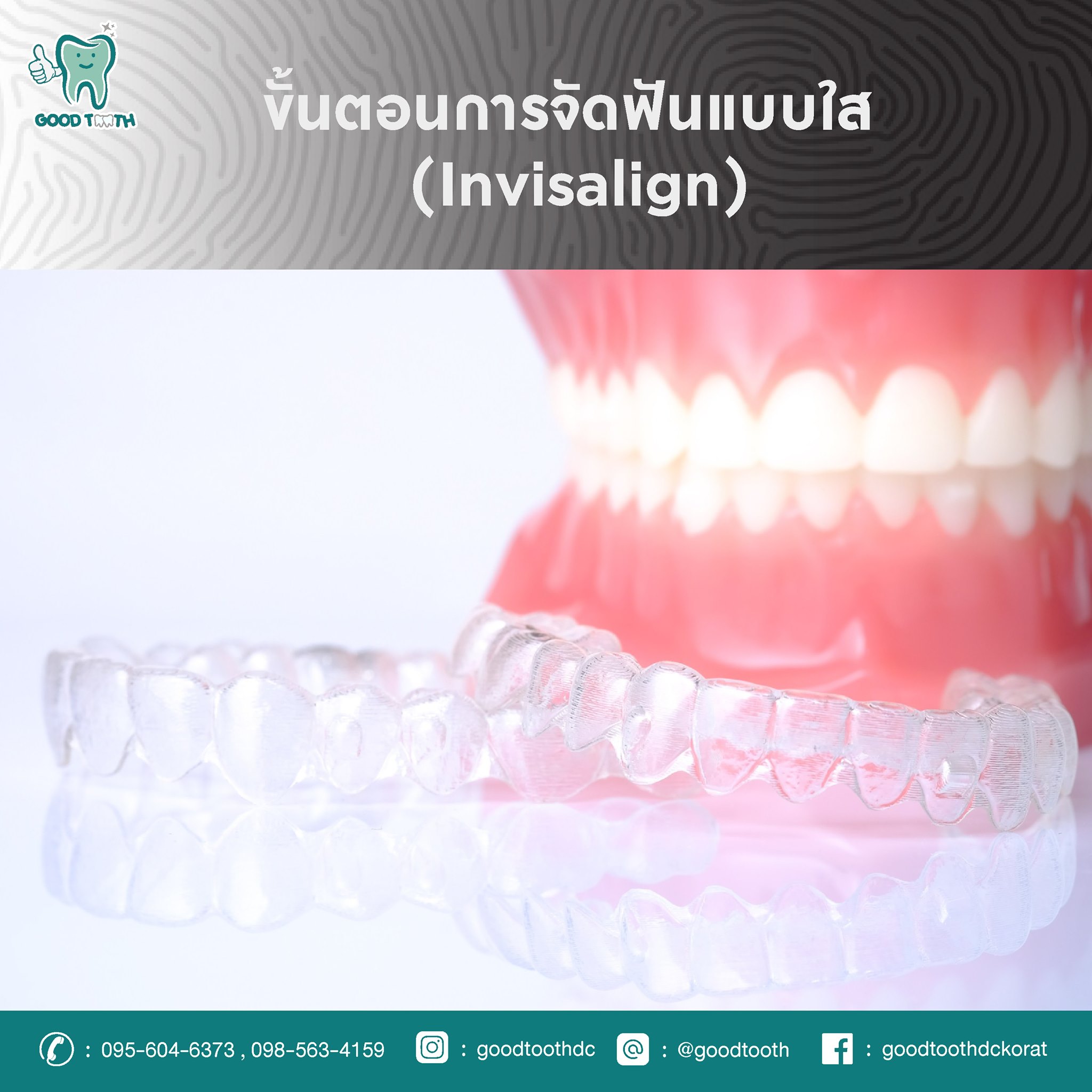 อยากรู้ว่า การจัดฟันใสคืออะไร ทำยังไง วันนี้เรามาดูกันค่ะว่าขั้นตอนการ ...