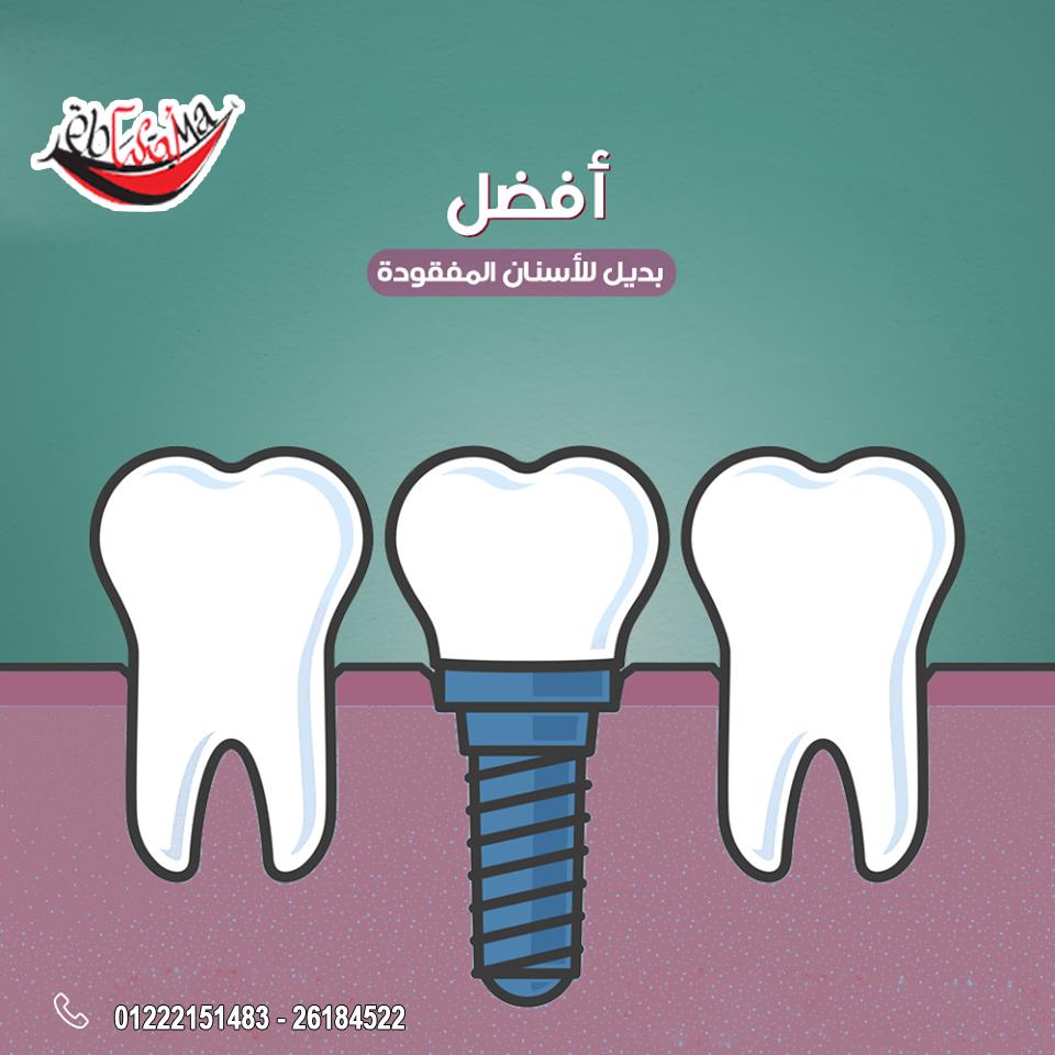Ebtsama Dental Clinic ليه زراعة الاسنان أفضل بديل للاسنان المفقودة شبيهة بالاسنان الطبيعة أكثر شعور ا بالراحة مريحة اثناء المضغ ضمان مدي الحياة في Ebtsama Dental Clinic بنضمن لك
