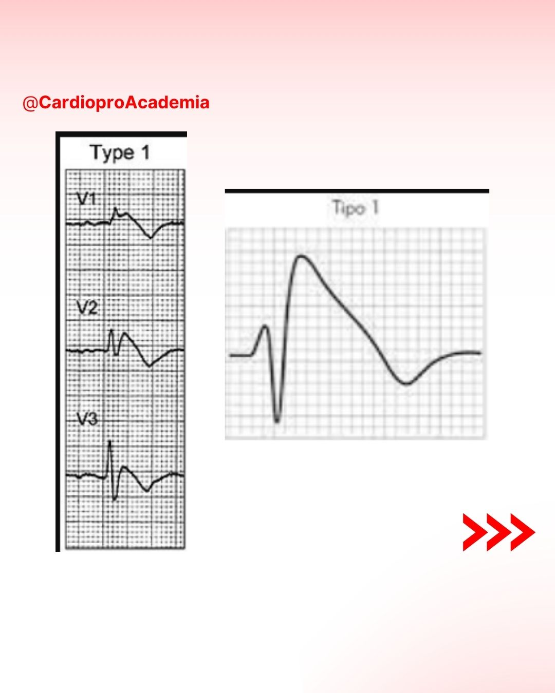 El síndrome de Brugada es una... - CardioPro Academia | Facebook